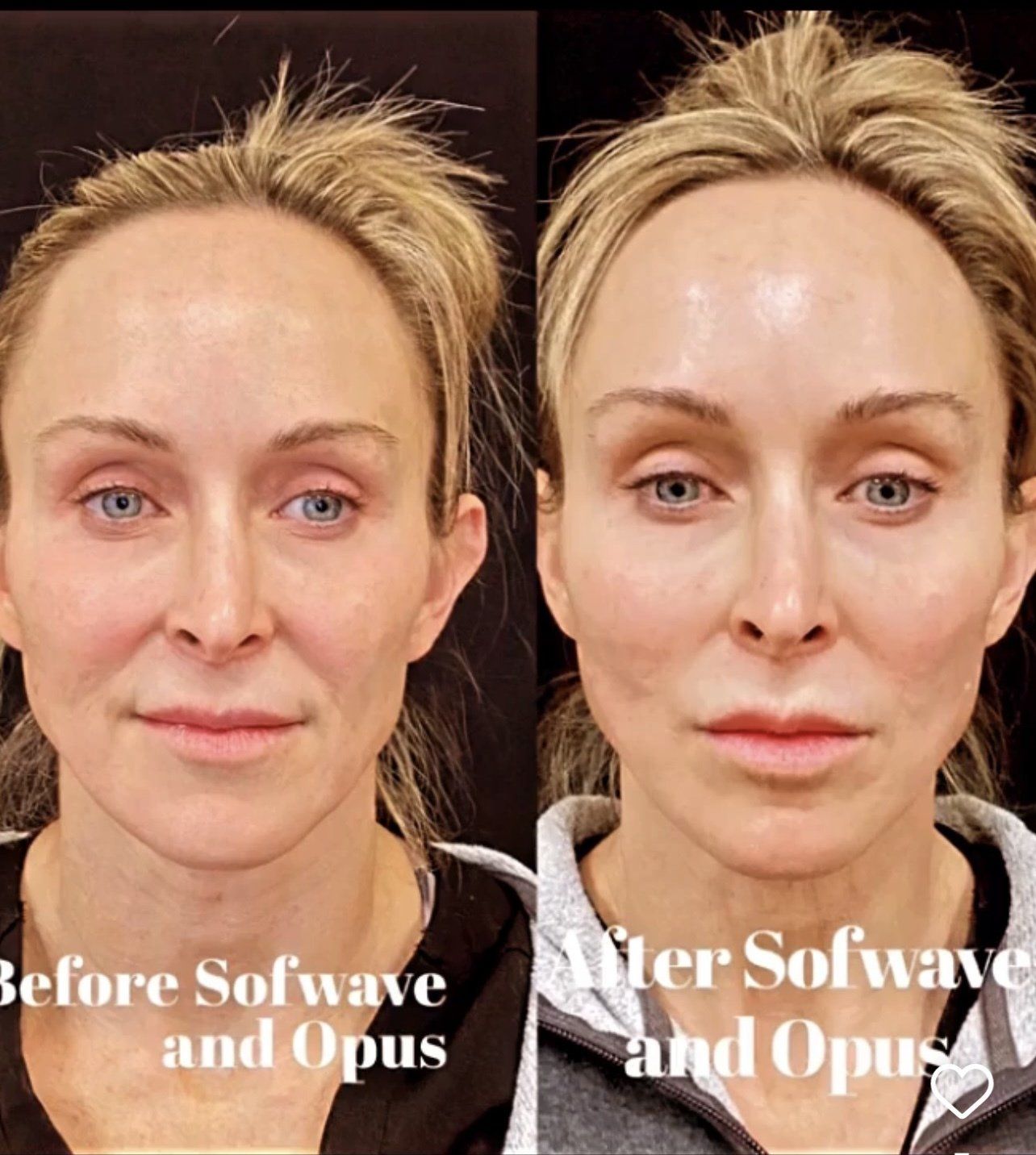 Sofwave face lift - before and after 3