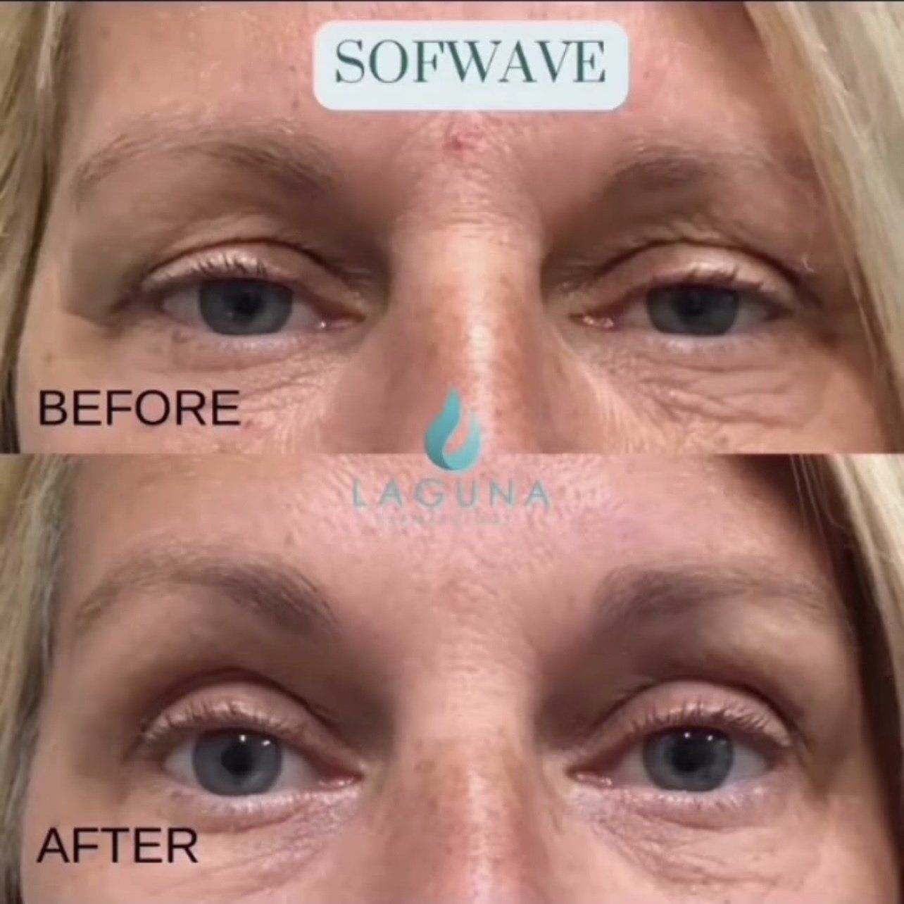 Sofwave face lift - before and after 4