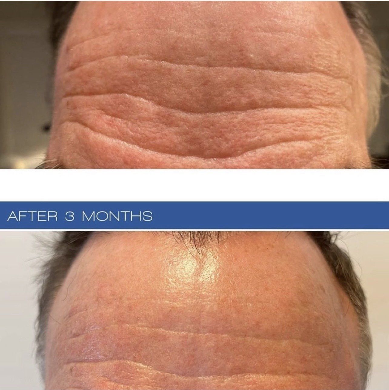Sofwave face lift - before and after 2