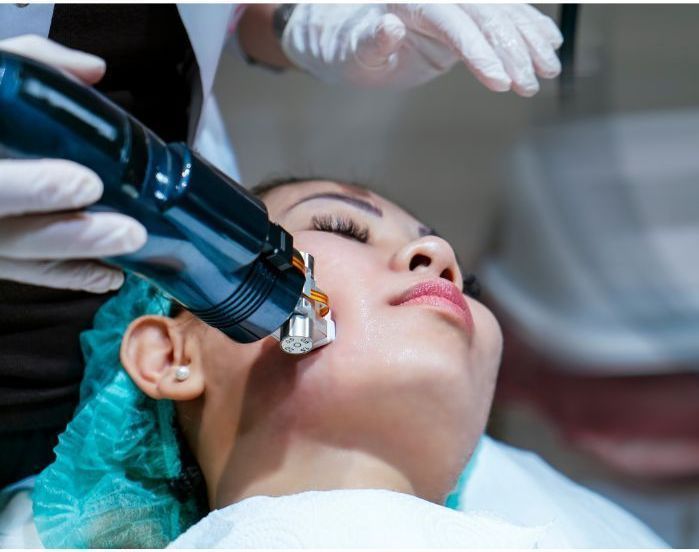 Microneedling for the complexion
