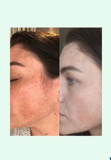 A before and after picture of a woman 's face with acne.