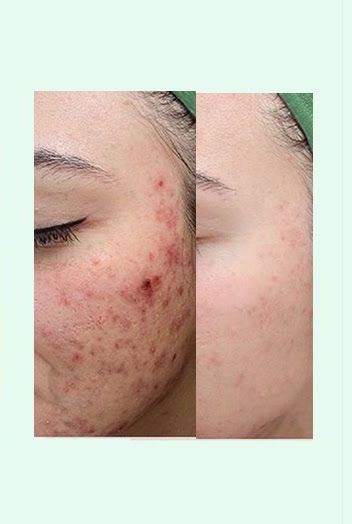 A before and after picture of a woman 's face with acne.