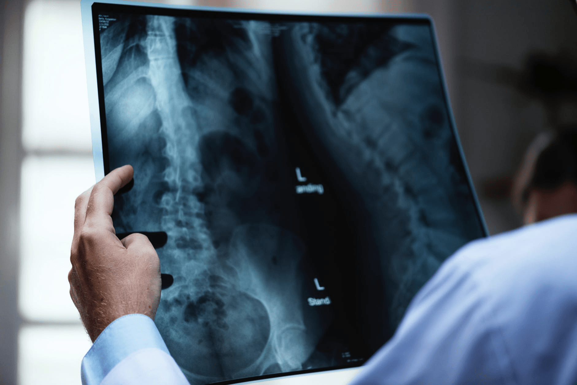 A doctor is looking at an x-ray of a person 's spine.