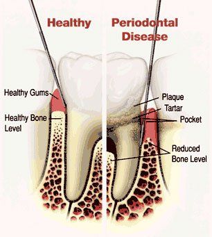 Healthy teeth  Vs Periodontal Disease