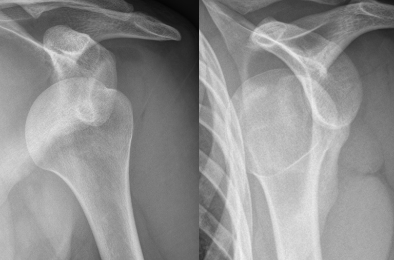 Two x-rays of a person 's shoulder showing a broken shoulder and a normal shoulder.