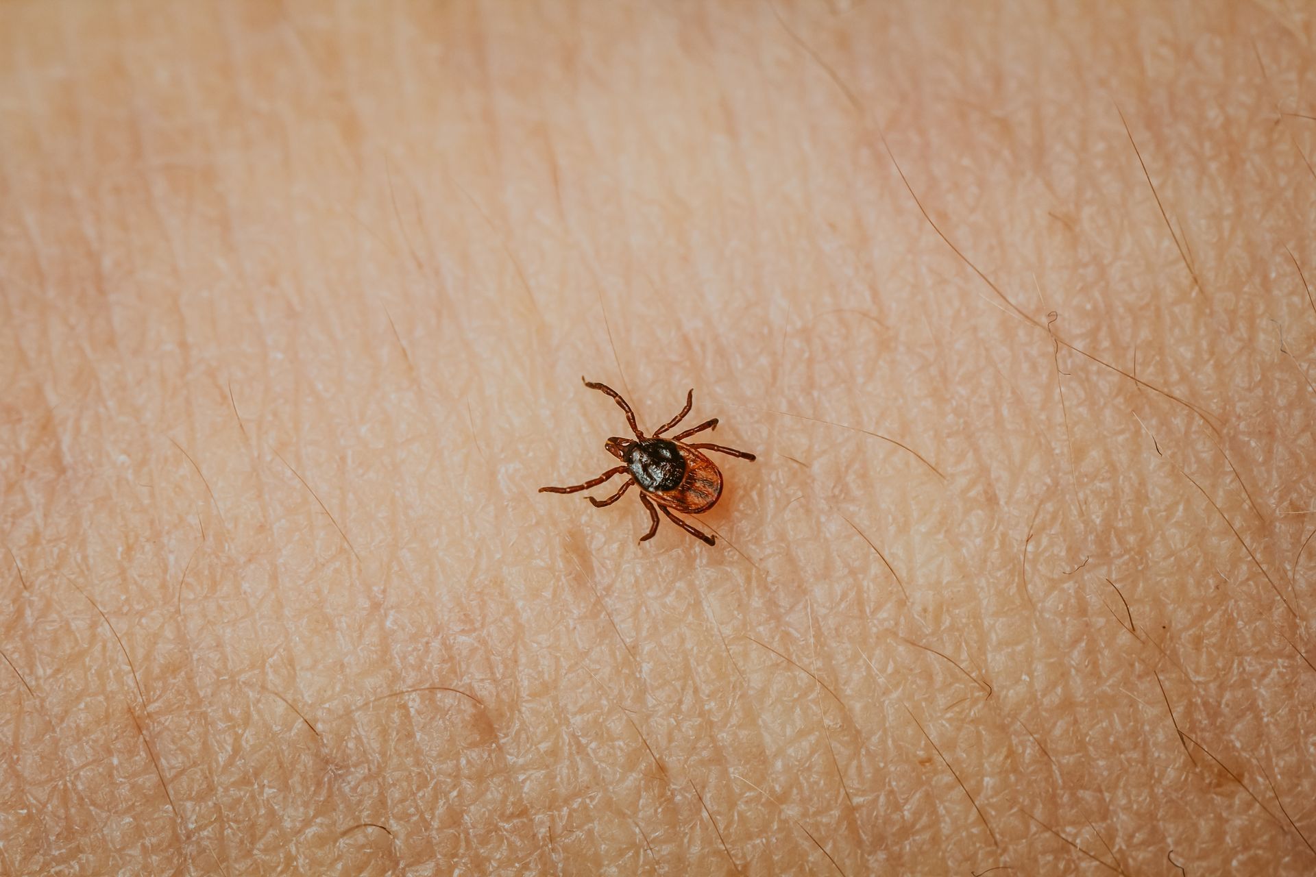 Tick embedded in human skin.