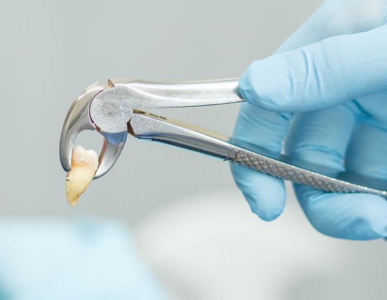 A person is holding a pair of pliers with a tooth in it.