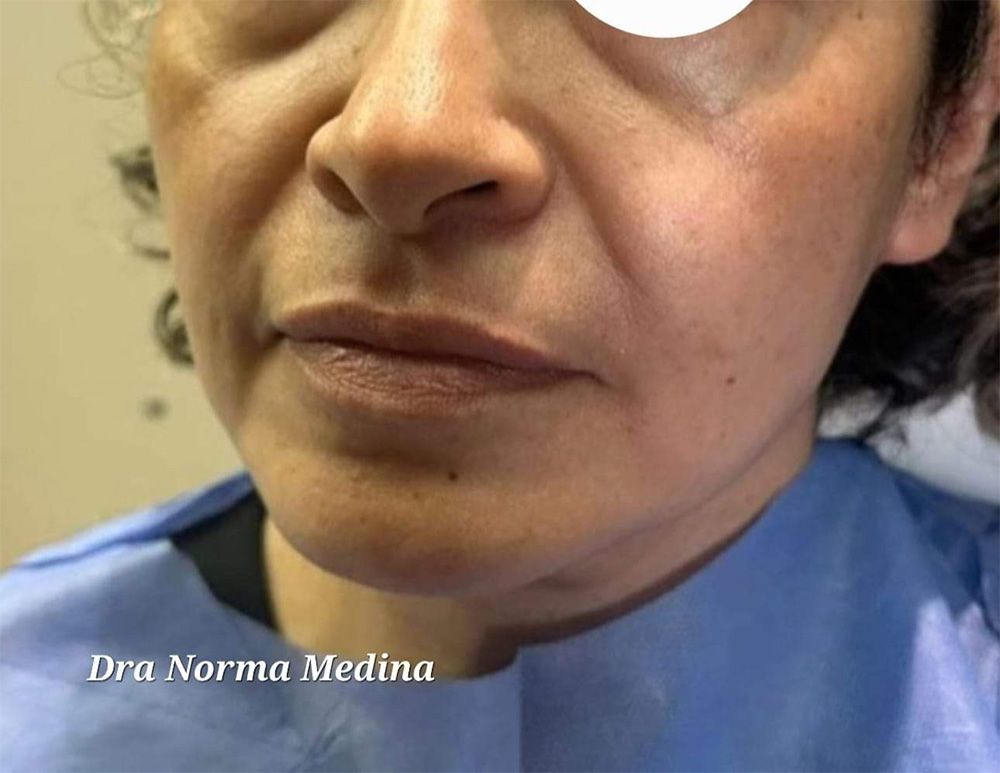 Armonización Facial