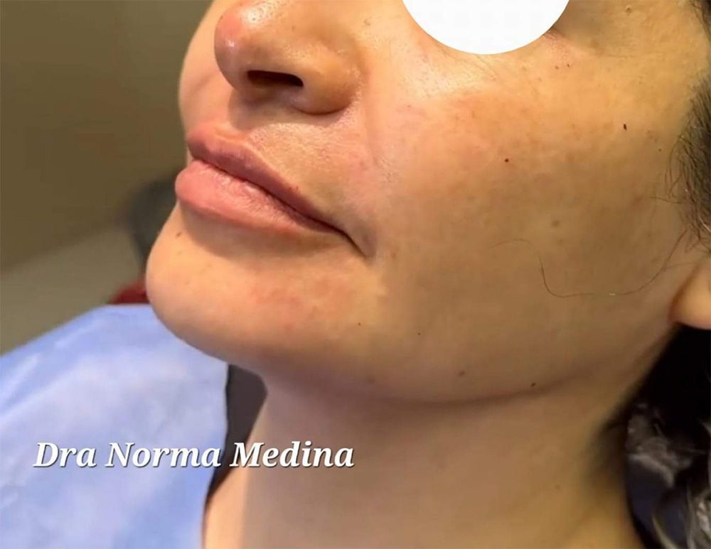 Armonización Facial