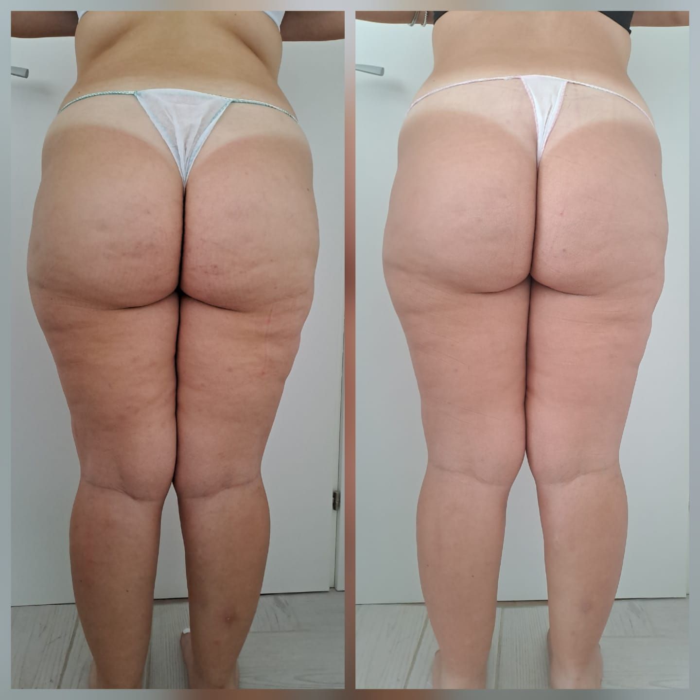 Vista prima e dopo di gambe e glutei, che mostra una riduzione della cellulite.