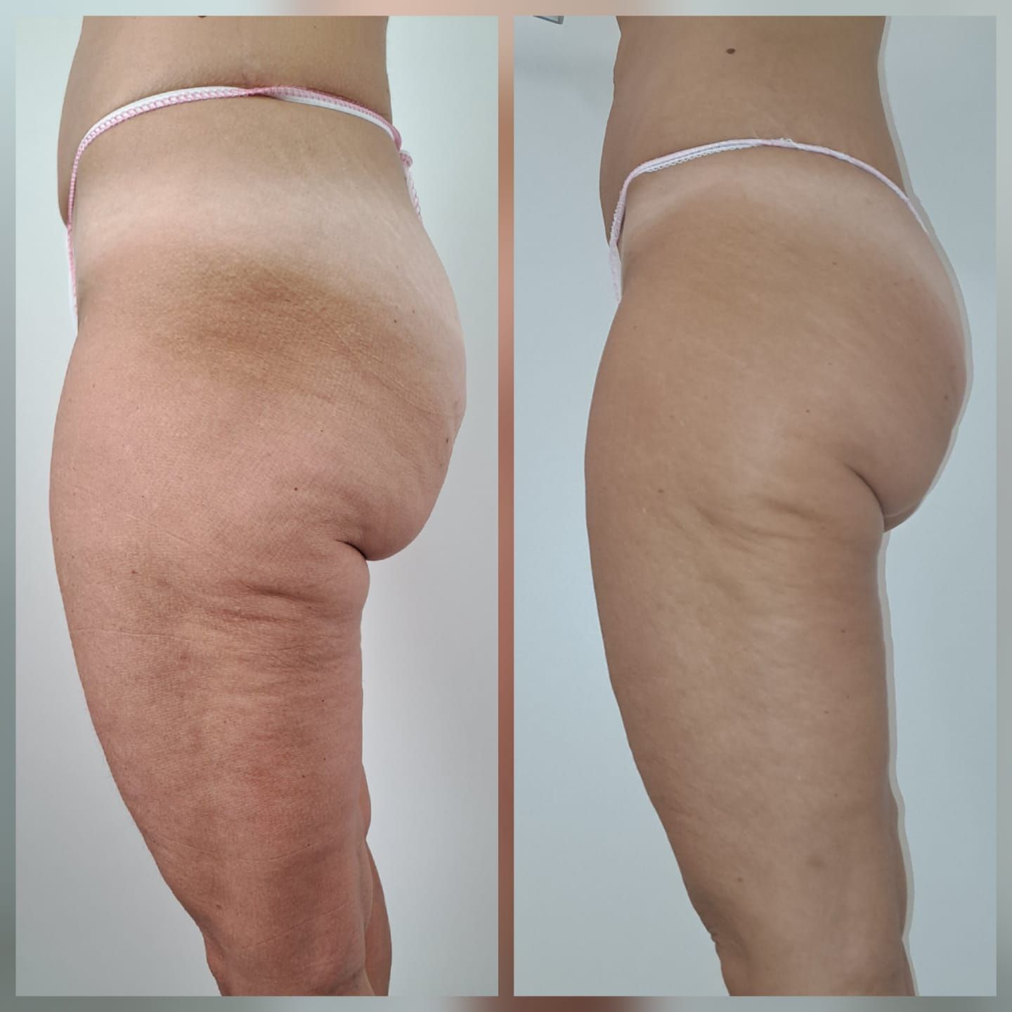 Foto prima e dopo di cosce e glutei di una persona; cellulite ridotta dopo il trattamento.