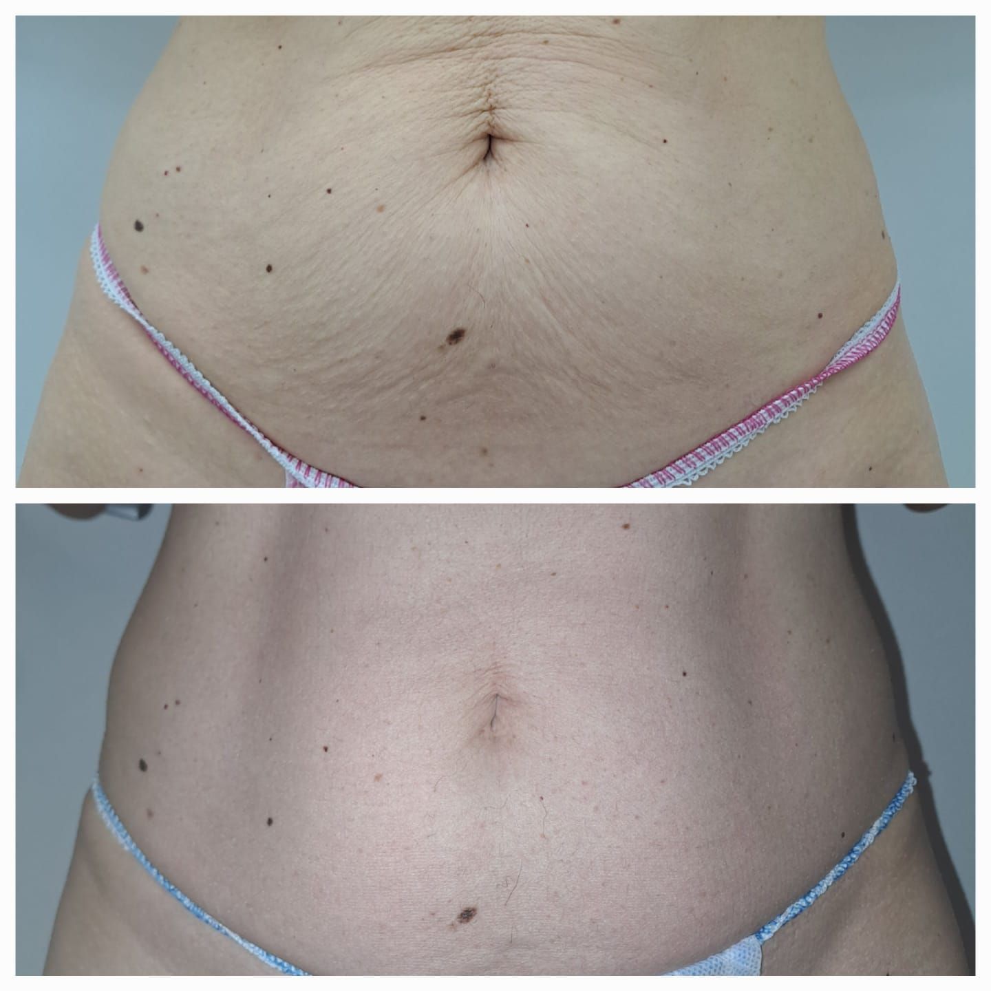 Confronto affiancato dell'addome di una persona, prima e dopo il trattamento, con ridotta lassità cutanea.