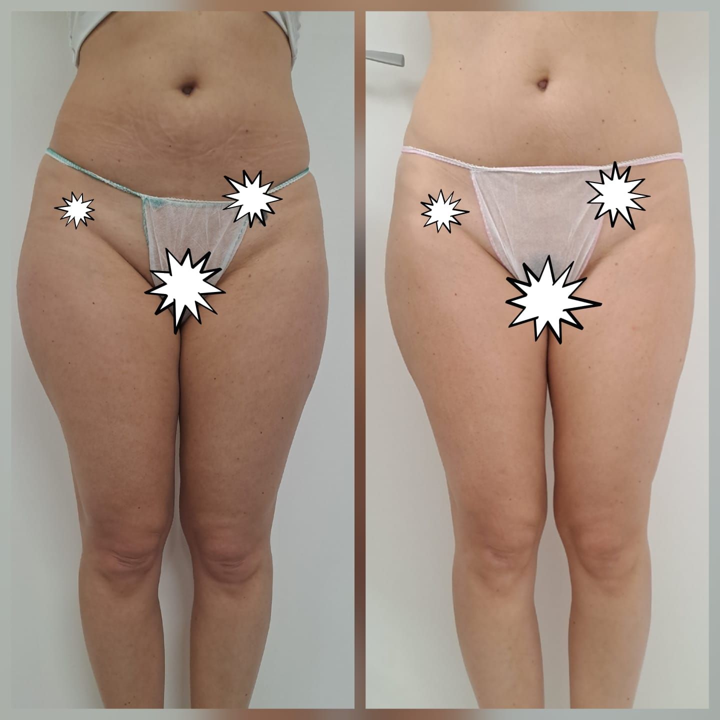 Confronto fianco a fianco: cosce prima e dopo il trattamento. La pelle appare più liscia e con meno cellulite.