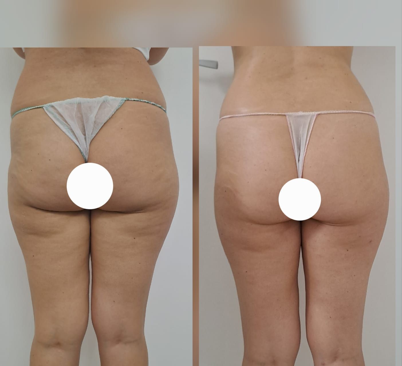 Prima e dopo di gambe e glutei. A sinistra si nota la cellulite. A destra la pelle è più liscia dopo il trattamento.