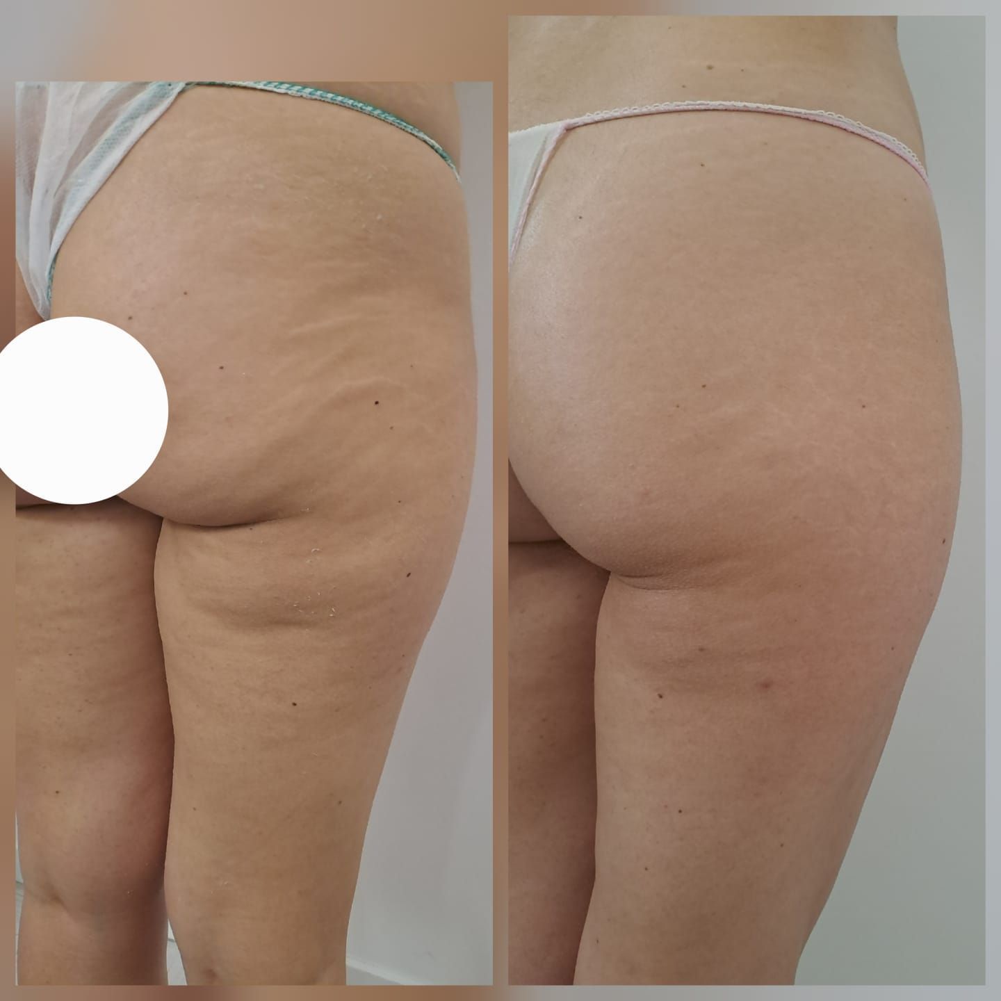 Prima e dopo dei glutei di una persona. 