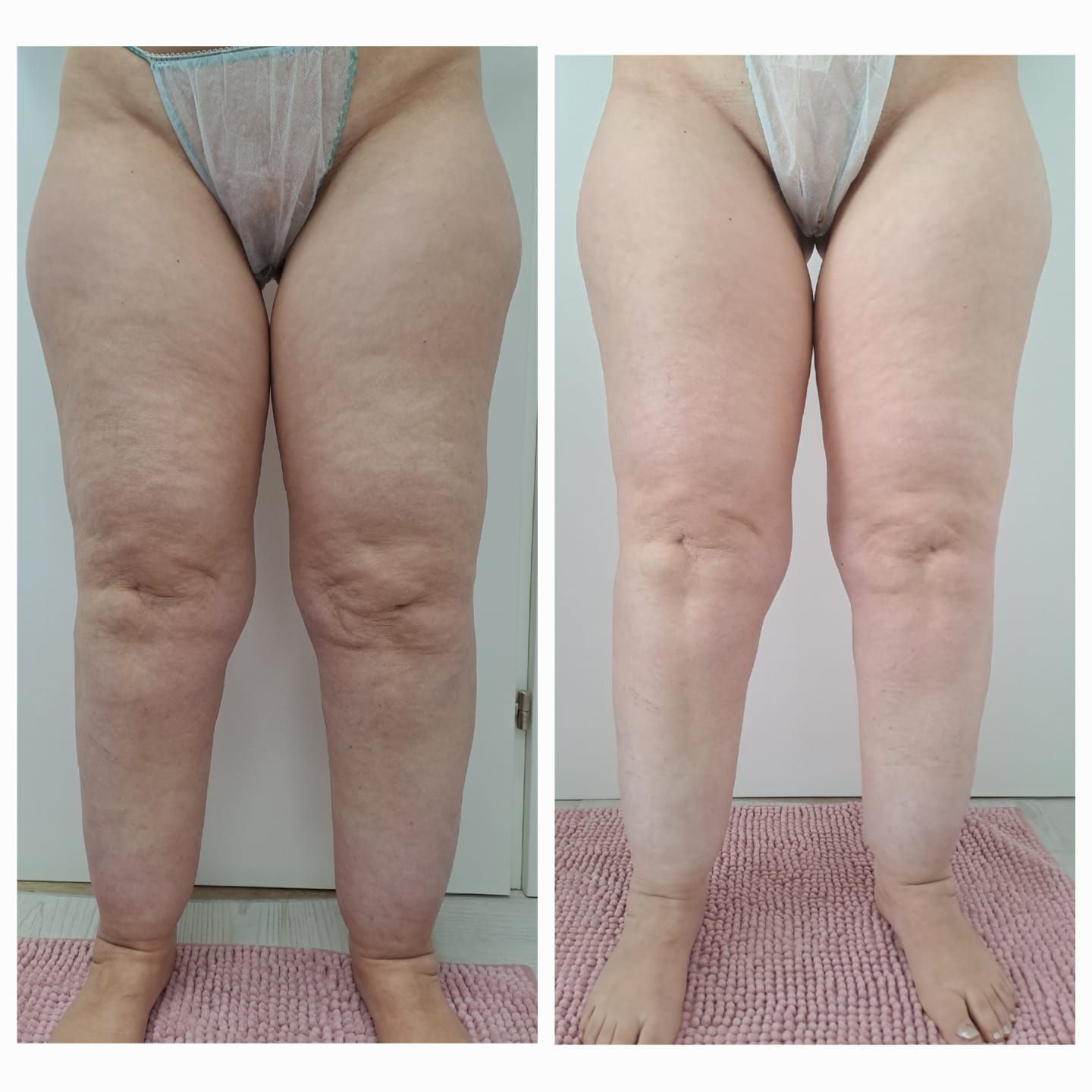 Gambe prima e dopo: aspetto della pelle delle cosce migliorato.