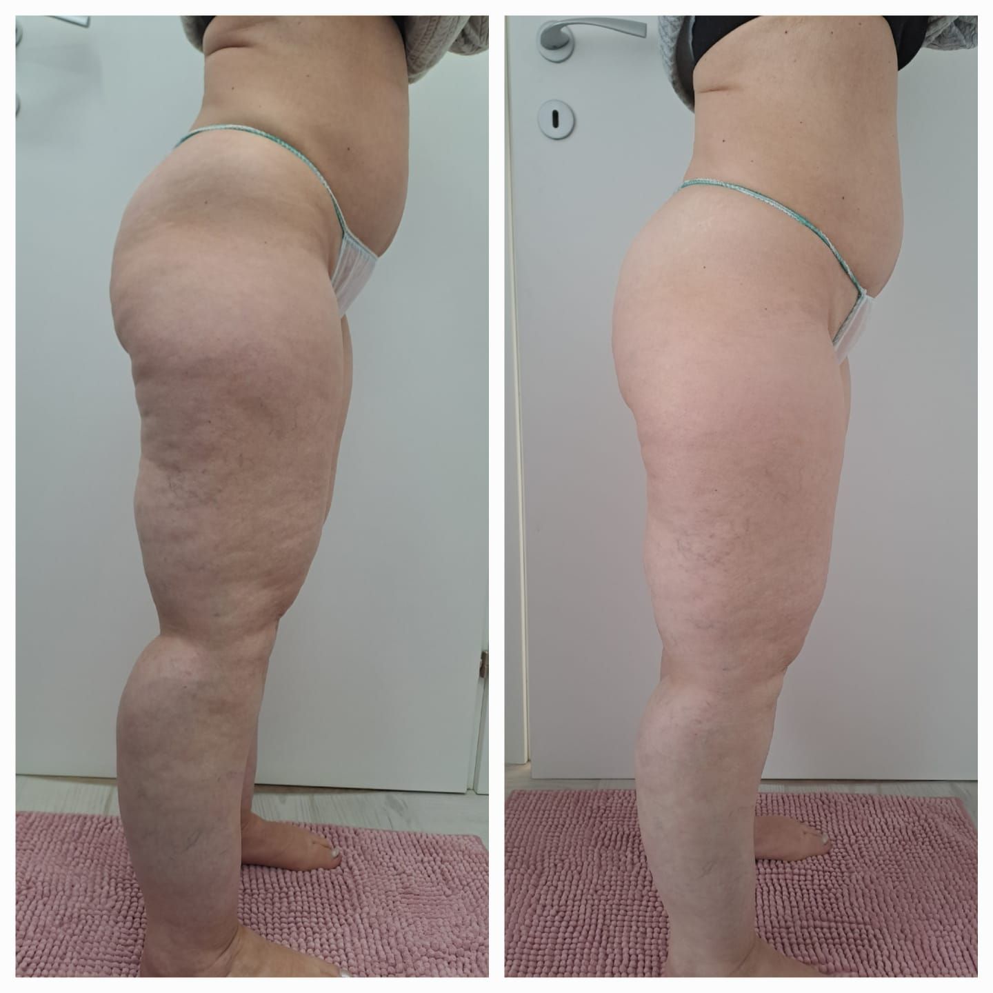 Prima e dopo di una gamba: a sinistra con cellulite, a destra più liscia dopo il trattamento. 