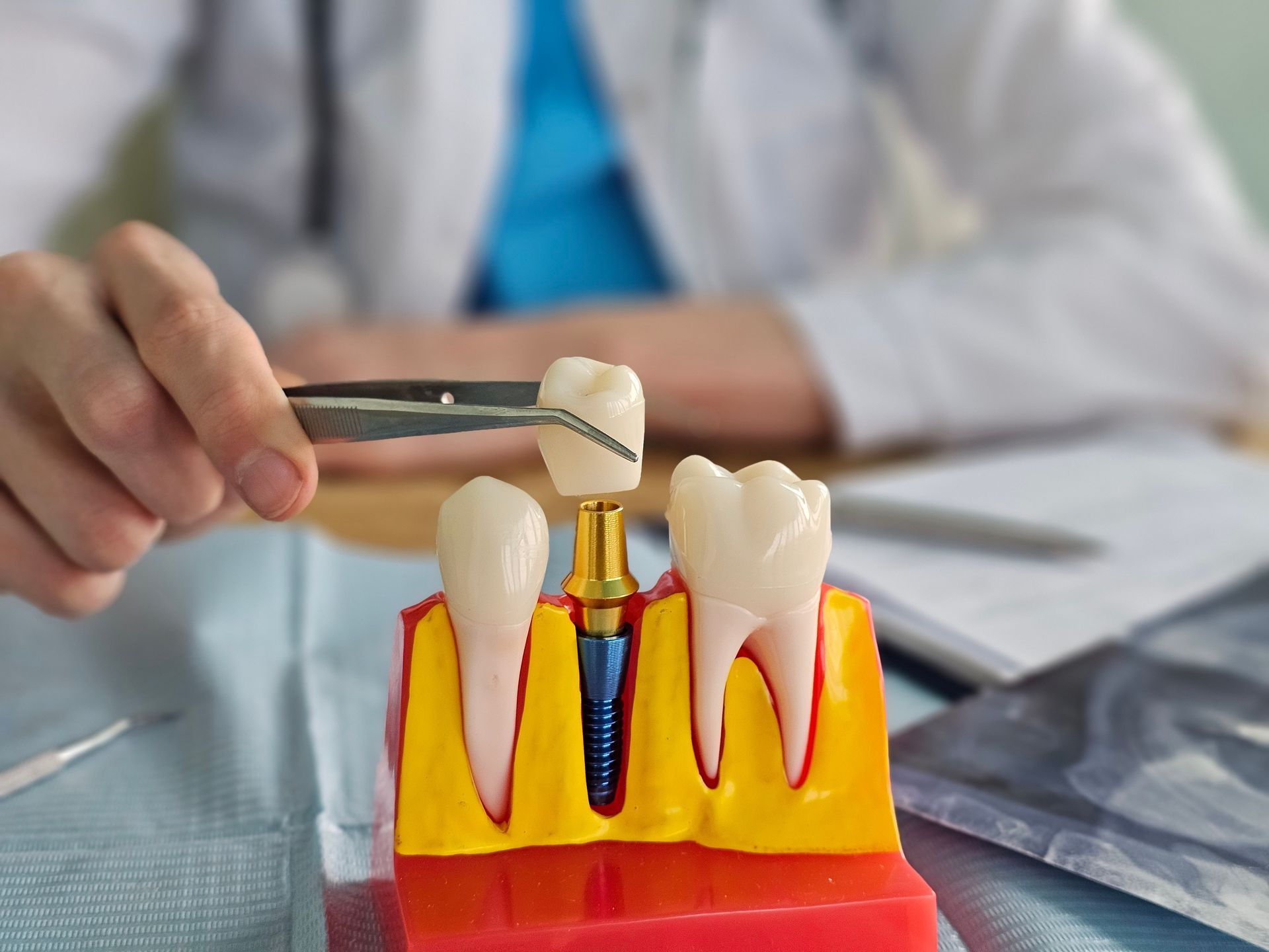 A dentist is placing a dental crown on a tooth model with an implant and gum display.