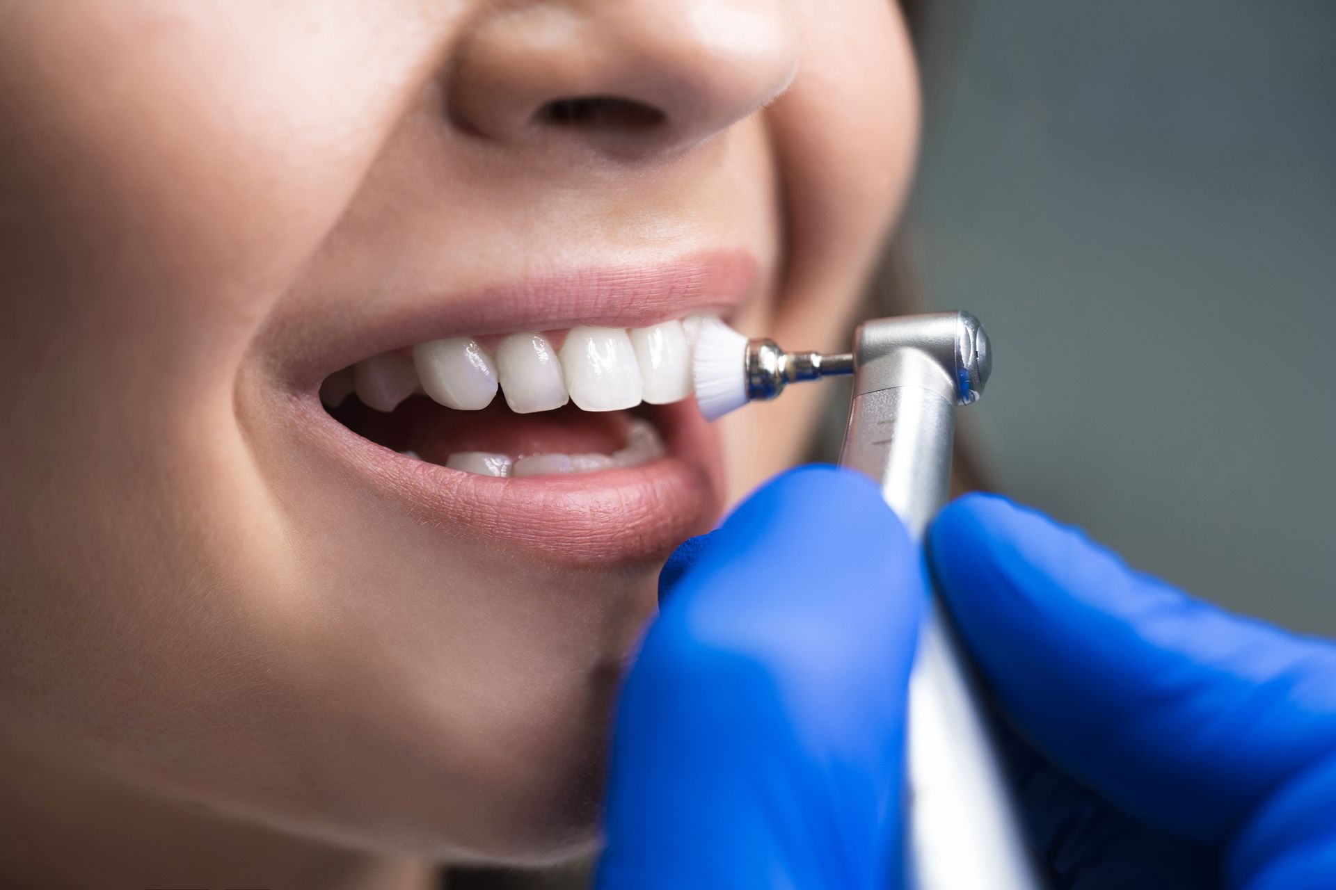 Dentist polishing teeth with a handheld tool and blue gloves.