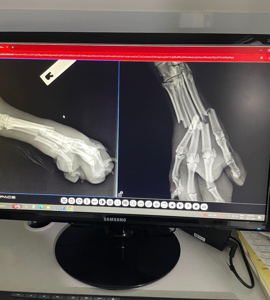 X-ray of a hand showing a severe fracture, displayed on a computer monitor.
