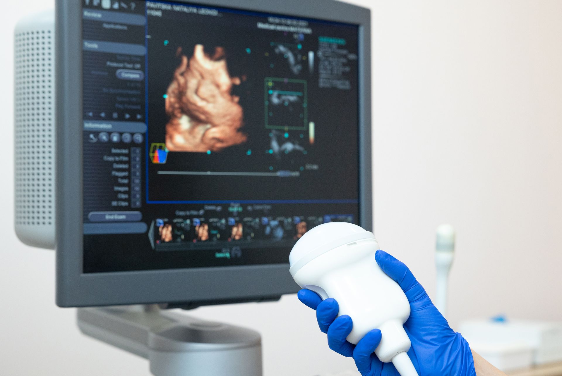 A person is holding an ultrasound probe in front of a monitor.