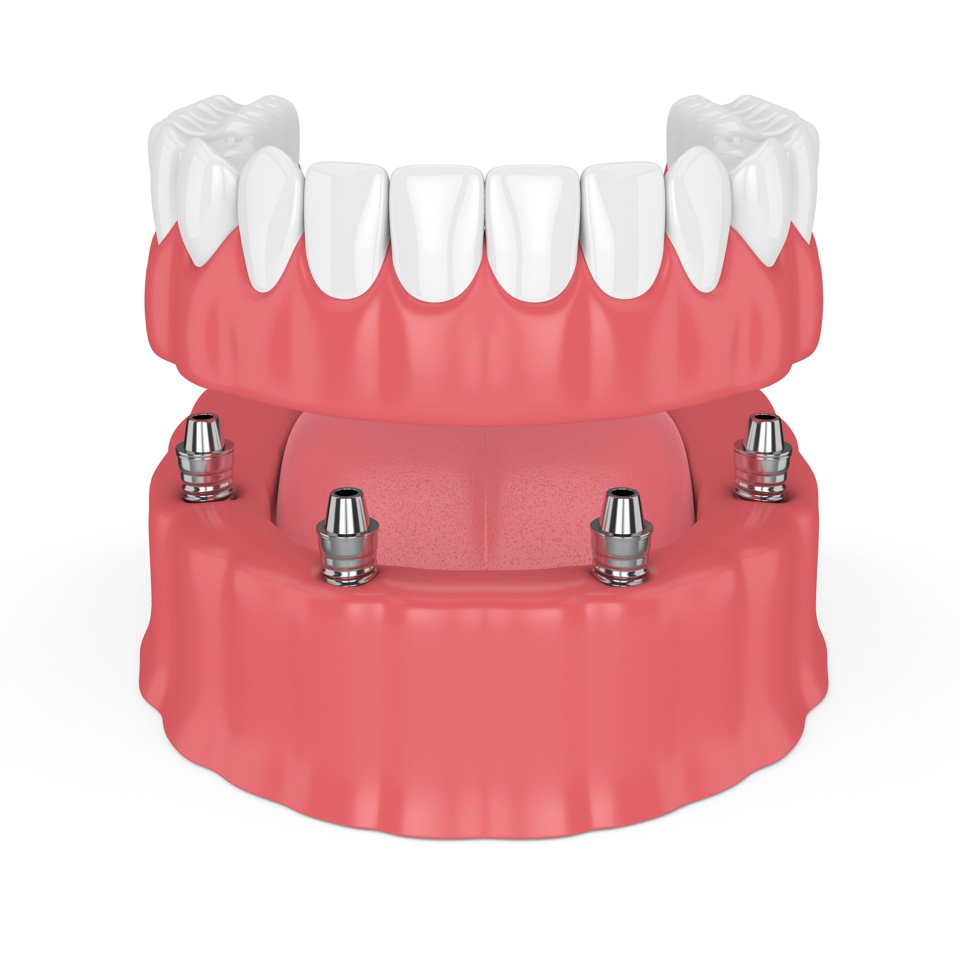 tulsa implant-supported dentures