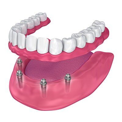 Implant Retained Dentures — Dentures And Mouthguards In Erina, NSW