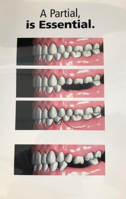 Partial Dentures Poster— Dentures And Mouthguards In Erina, NSW