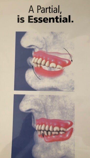 Dentures In Mouth Poster — Dentures And Mouthguards In Erina, NSW