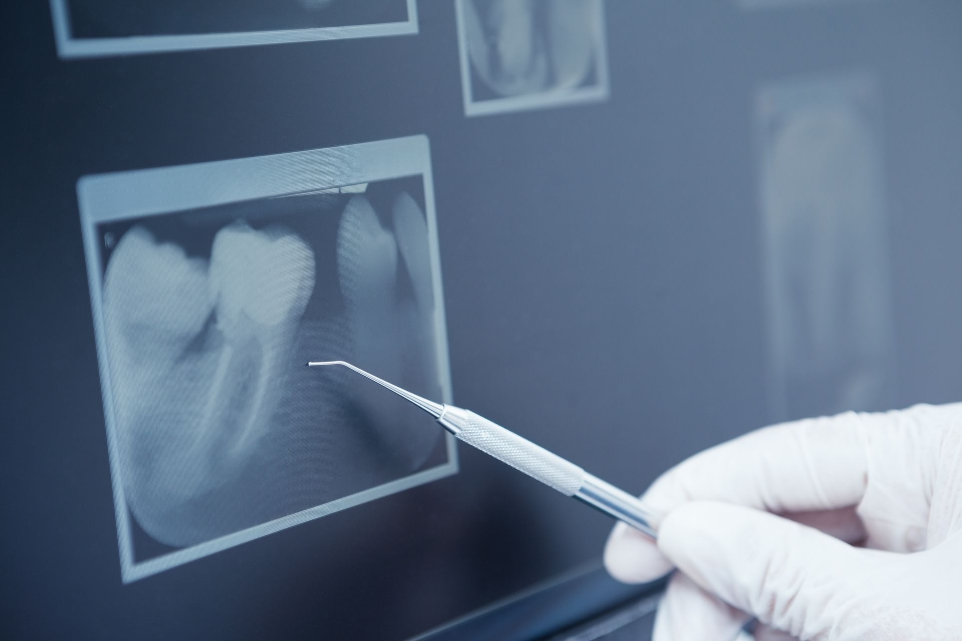 Dental X-ray with a gloved hand pointing with a dental tool.