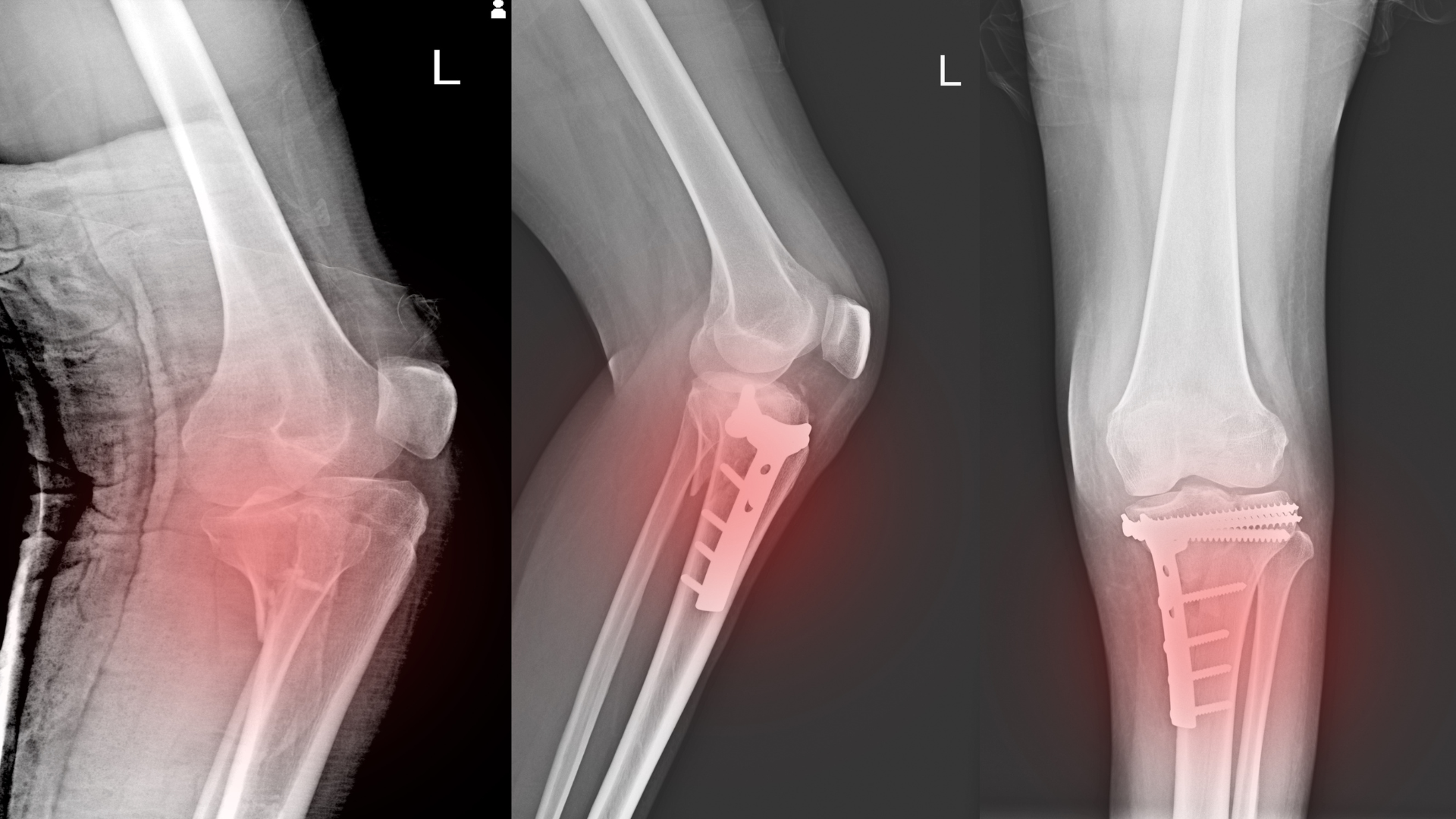 Three x-rays of a person 's knee with a knee replacement.