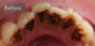 Before deep cleaning