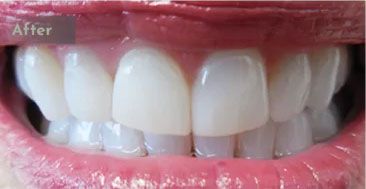 After Invisalign® treatment