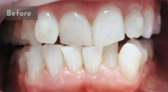 Before Invisalign® treatment
