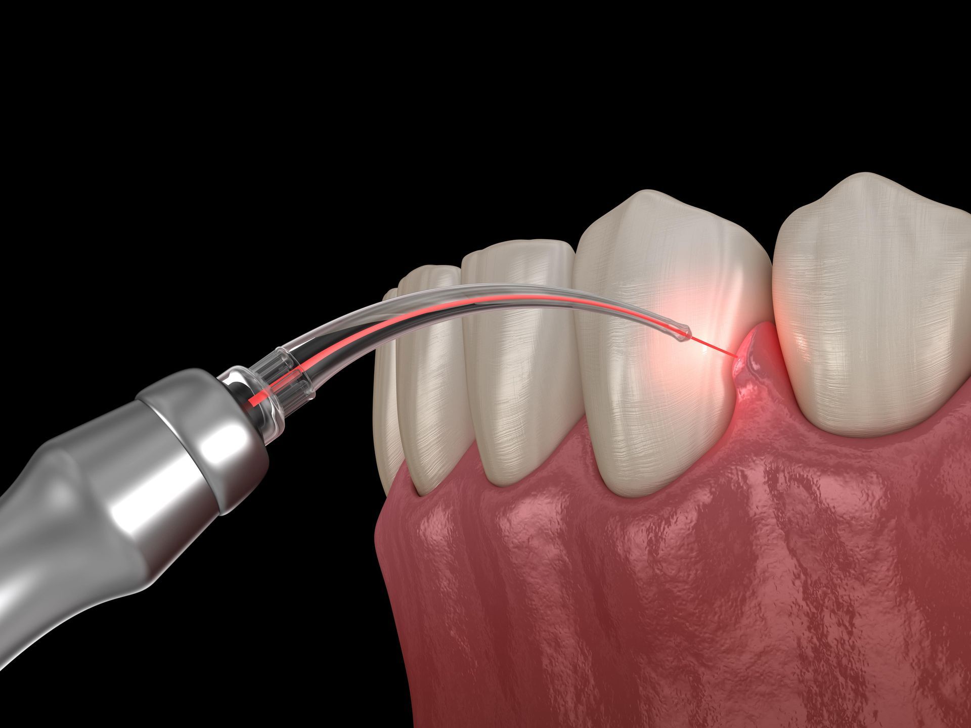 Why Laser Dentistry? The Game-Changer in Modern Dental Care