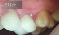 After laser gingivectomy