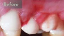 Before laser gingivectomy