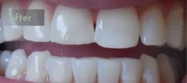 After Zoom whitening
