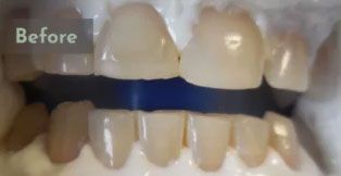 Before Zoom whitening