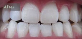 After Zoom whitening