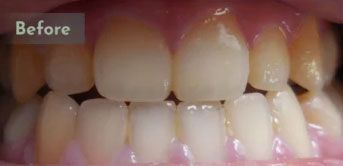 Before Zoom whitening