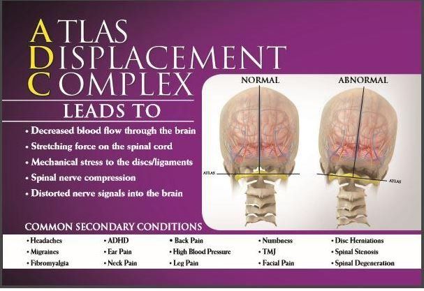 Atlas Displacement Complex displaying misalignment issues that cause pain and other health concerns