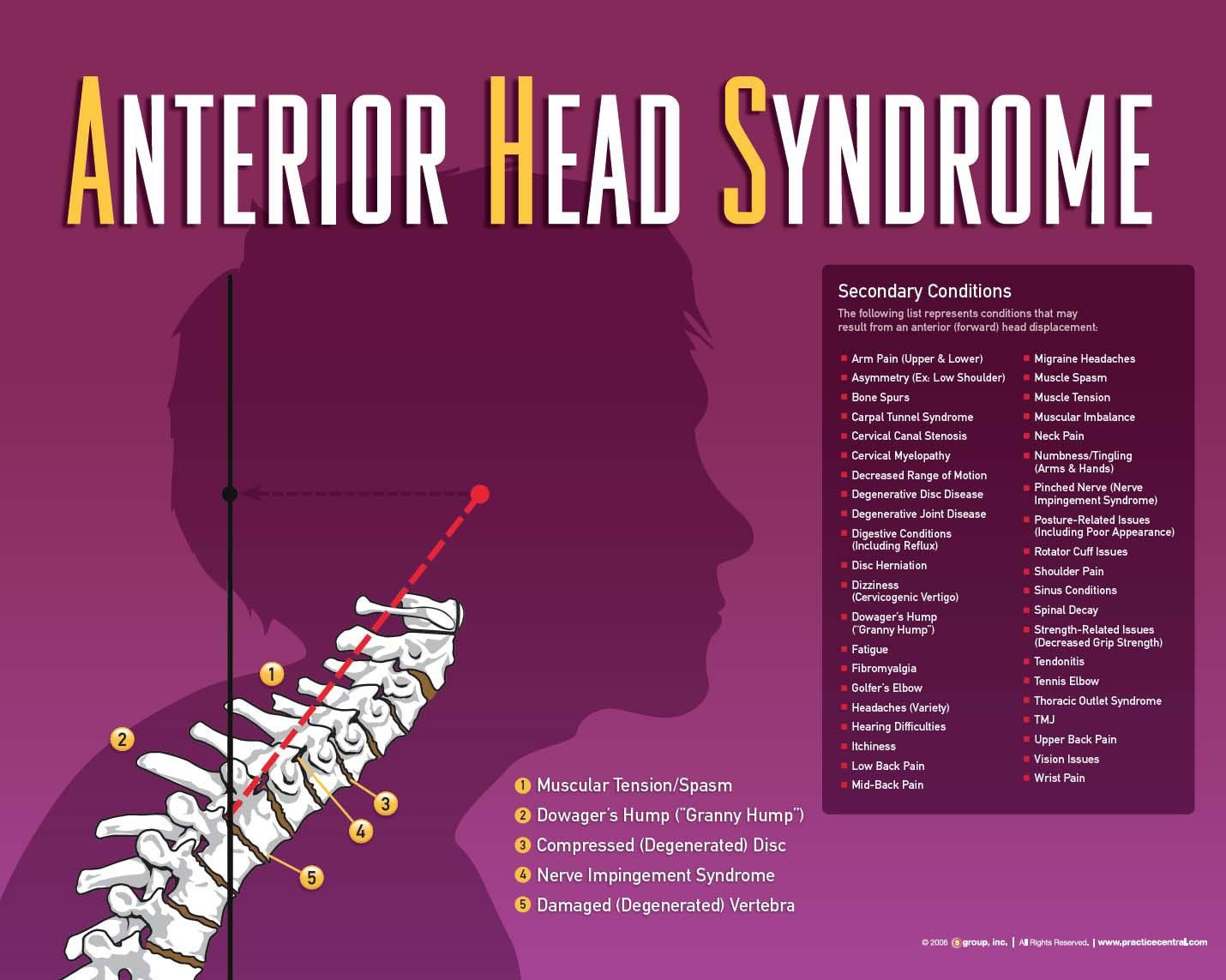 Diagram of Anterior Head Syndrome