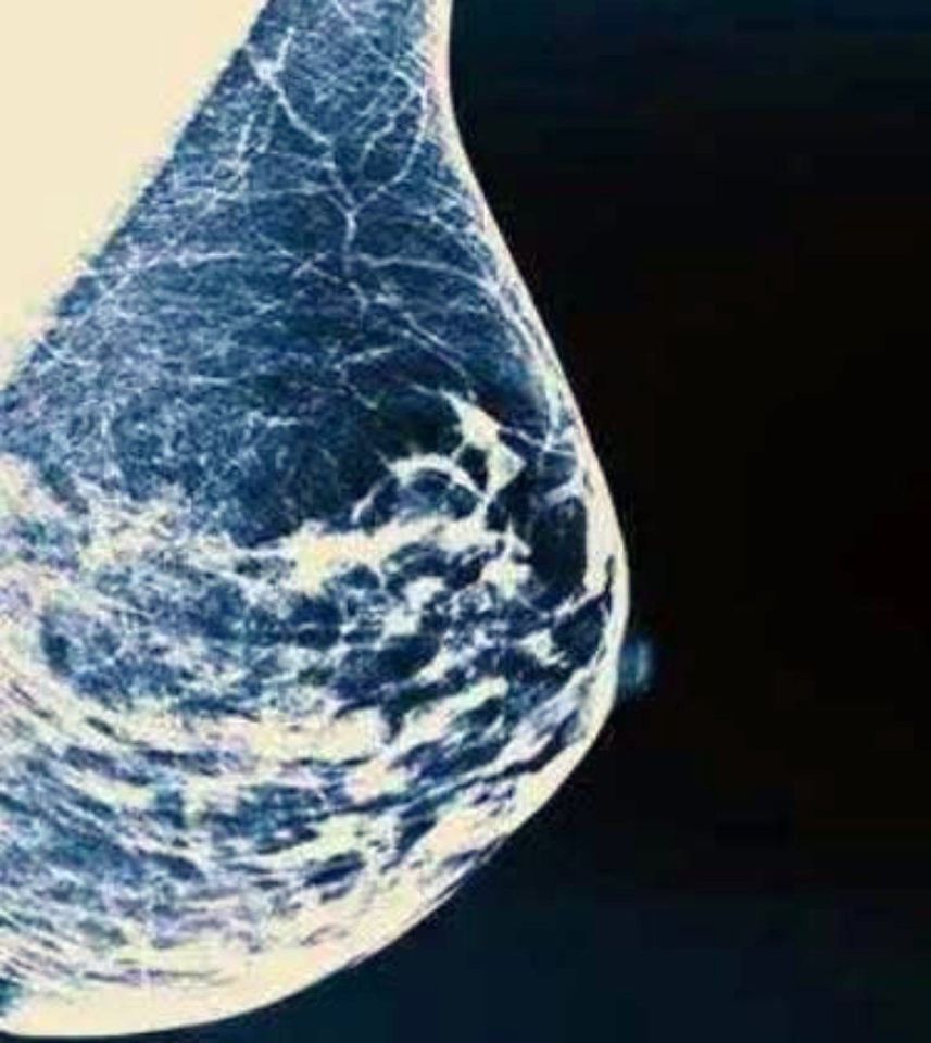 mammografia periodica