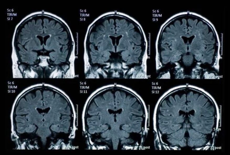 risonanza magnetica al cervello