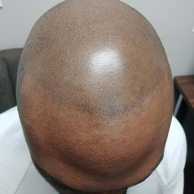 A close up of a man 's bald head.