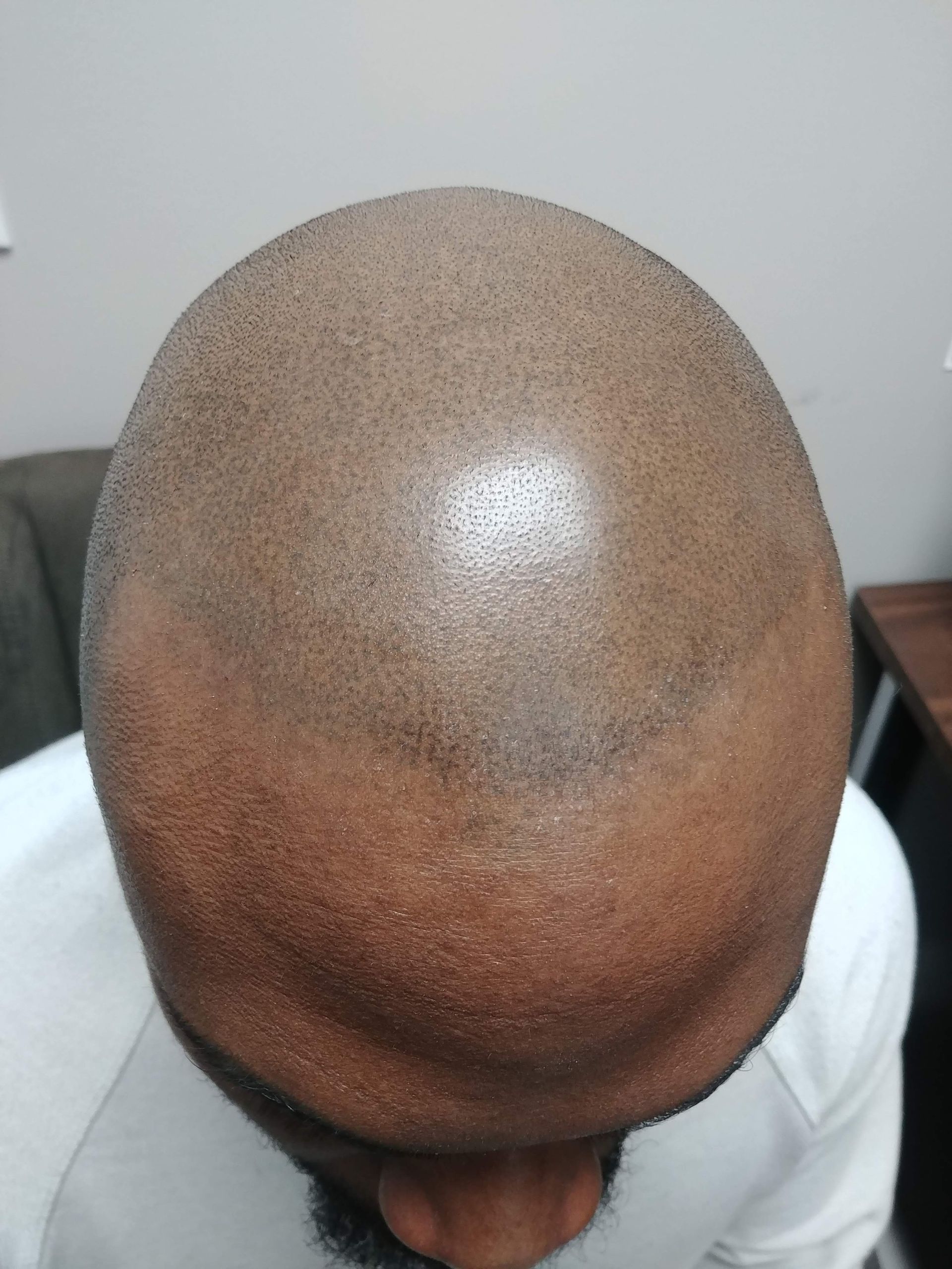 Close-up of a person's shaved head, with visible scalp. The head is light brown.