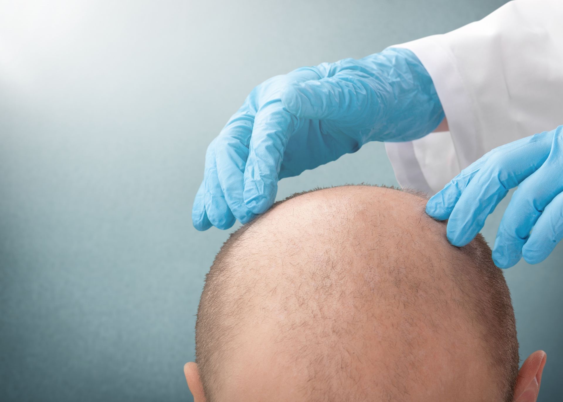 A doctor is examining a man 's bald head with blue gloves.