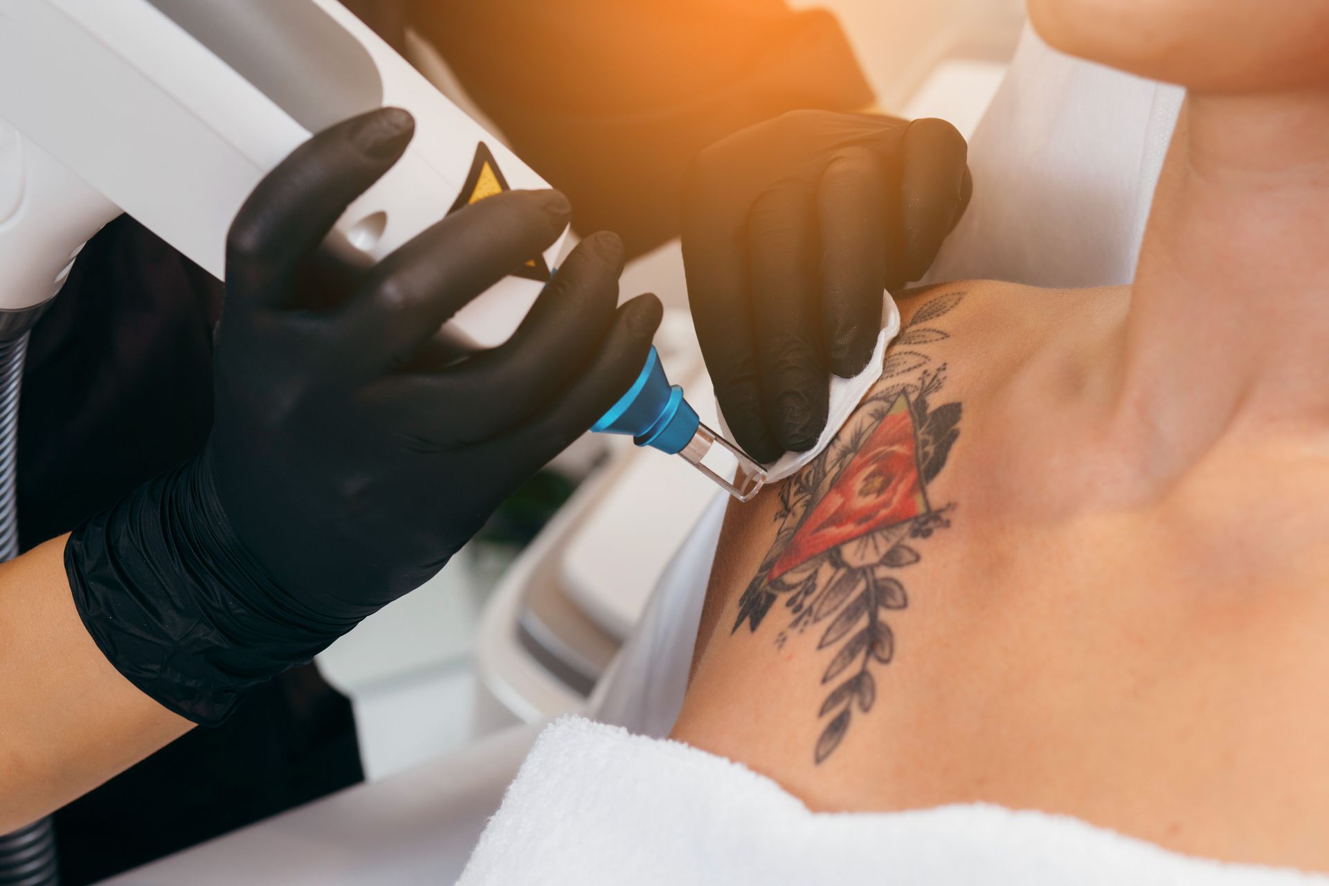 A woman is getting a tattoo removed from her shoulder.
