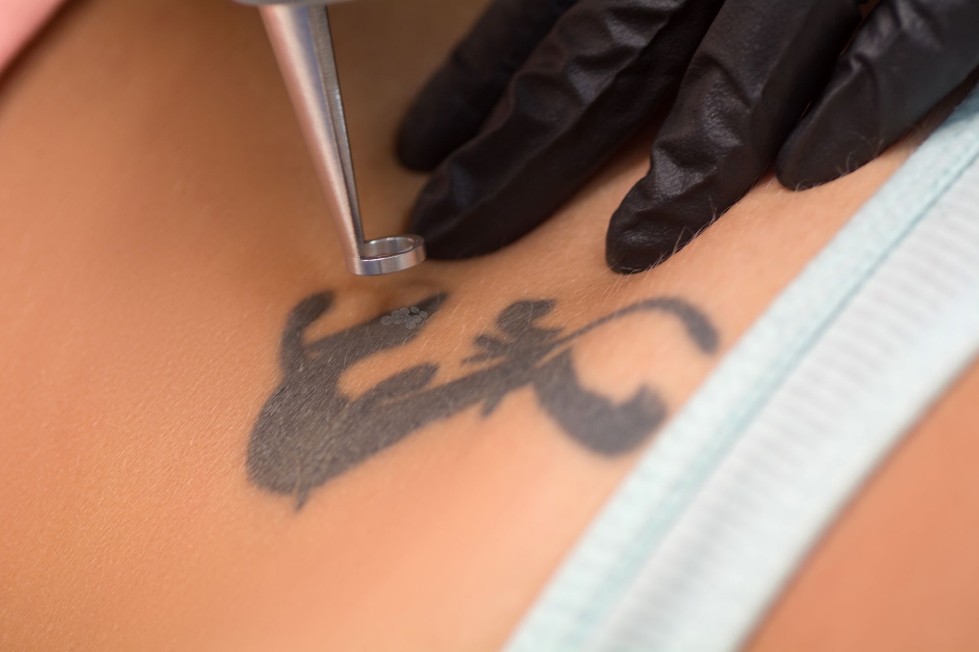 A woman is getting a tattoo removed from her back.
